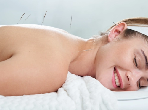 Acupuncture